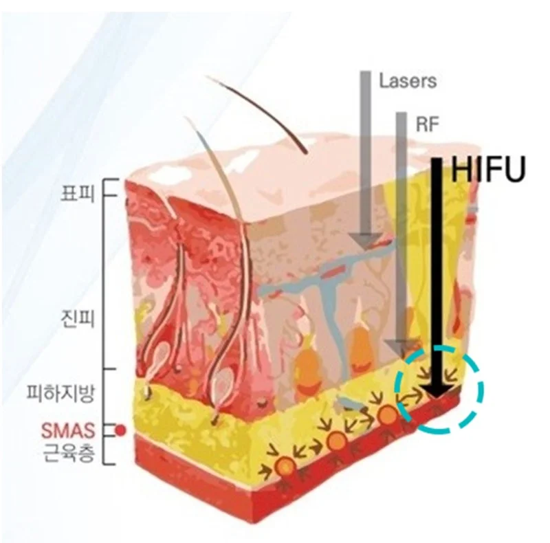 Comparison chart: HIFU vs radiofrequency vs laser energy delivery